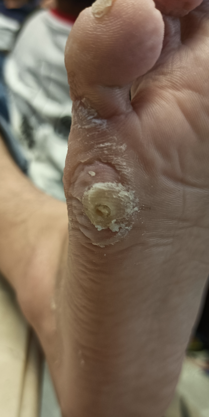 在治疗中的状态，跖疣已经十多年了